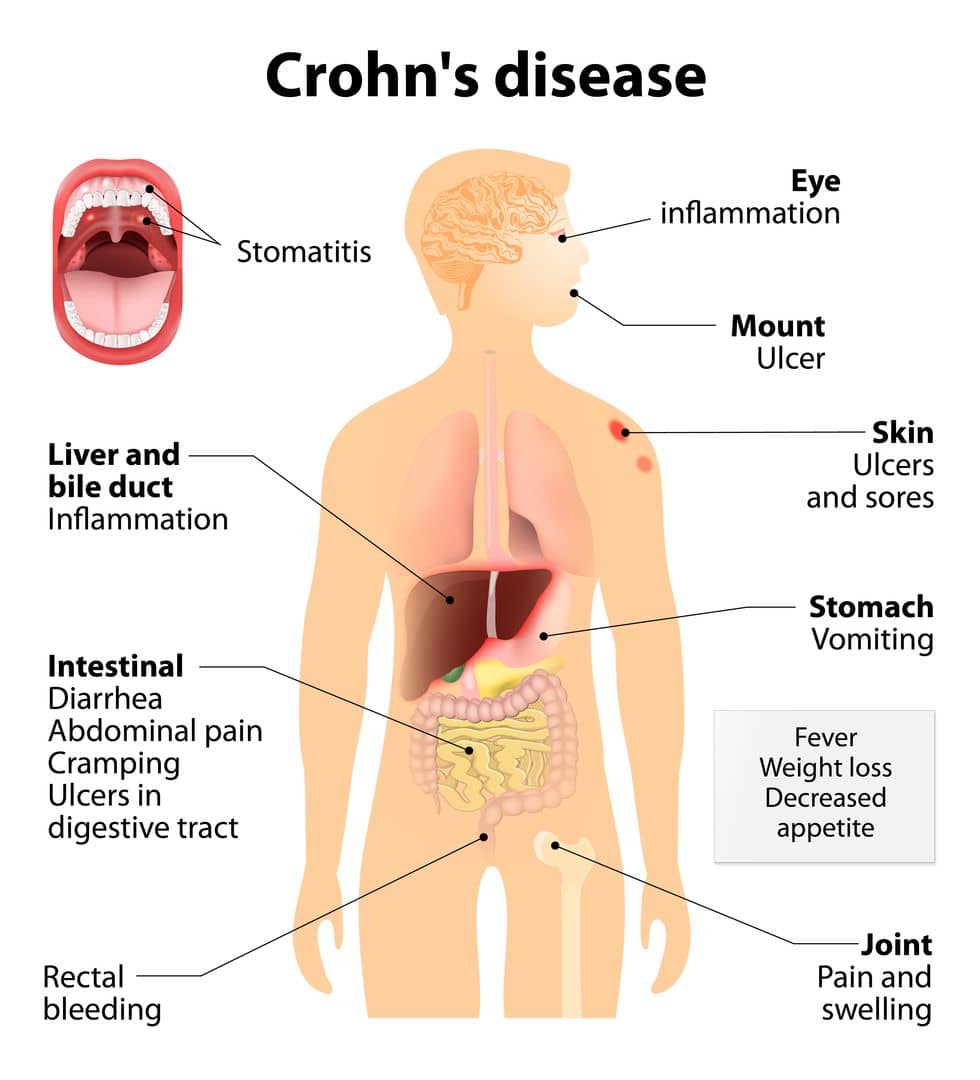 Crohn's Disease 