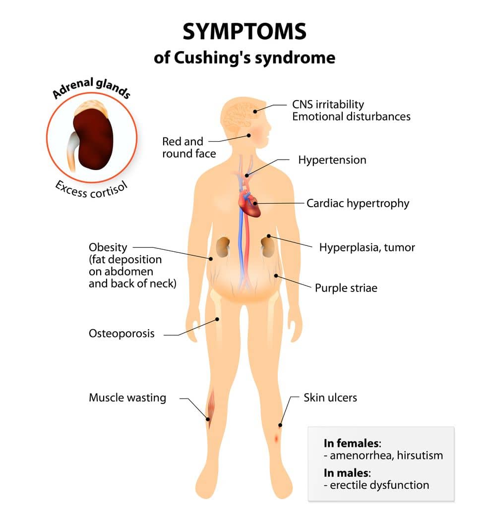 Cushings Syndrome 