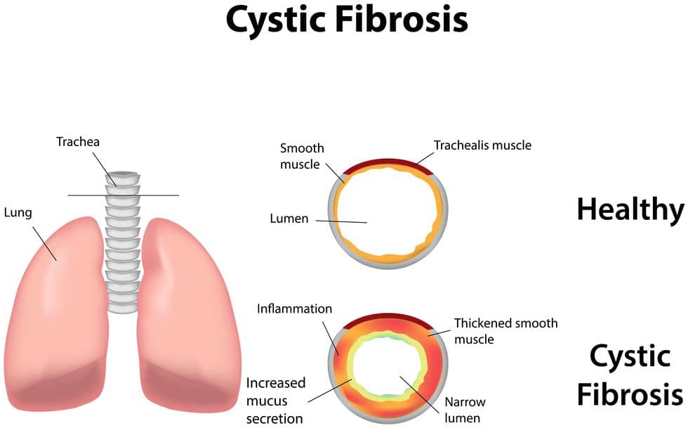 Cystic Fibrosis