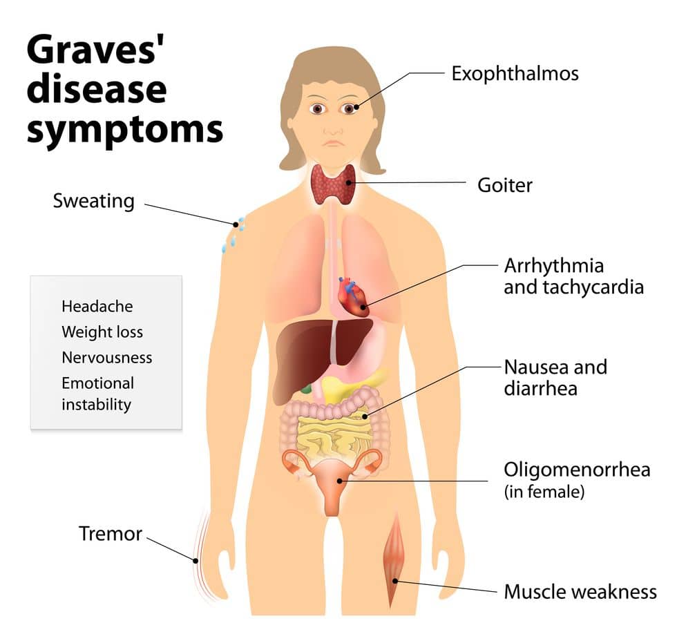 Graves Disease 