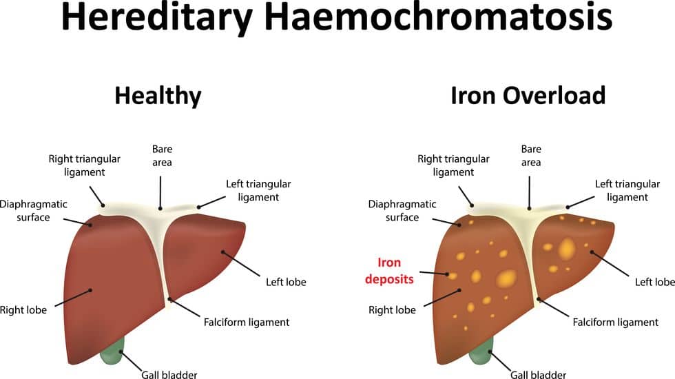 Hemochromatosis