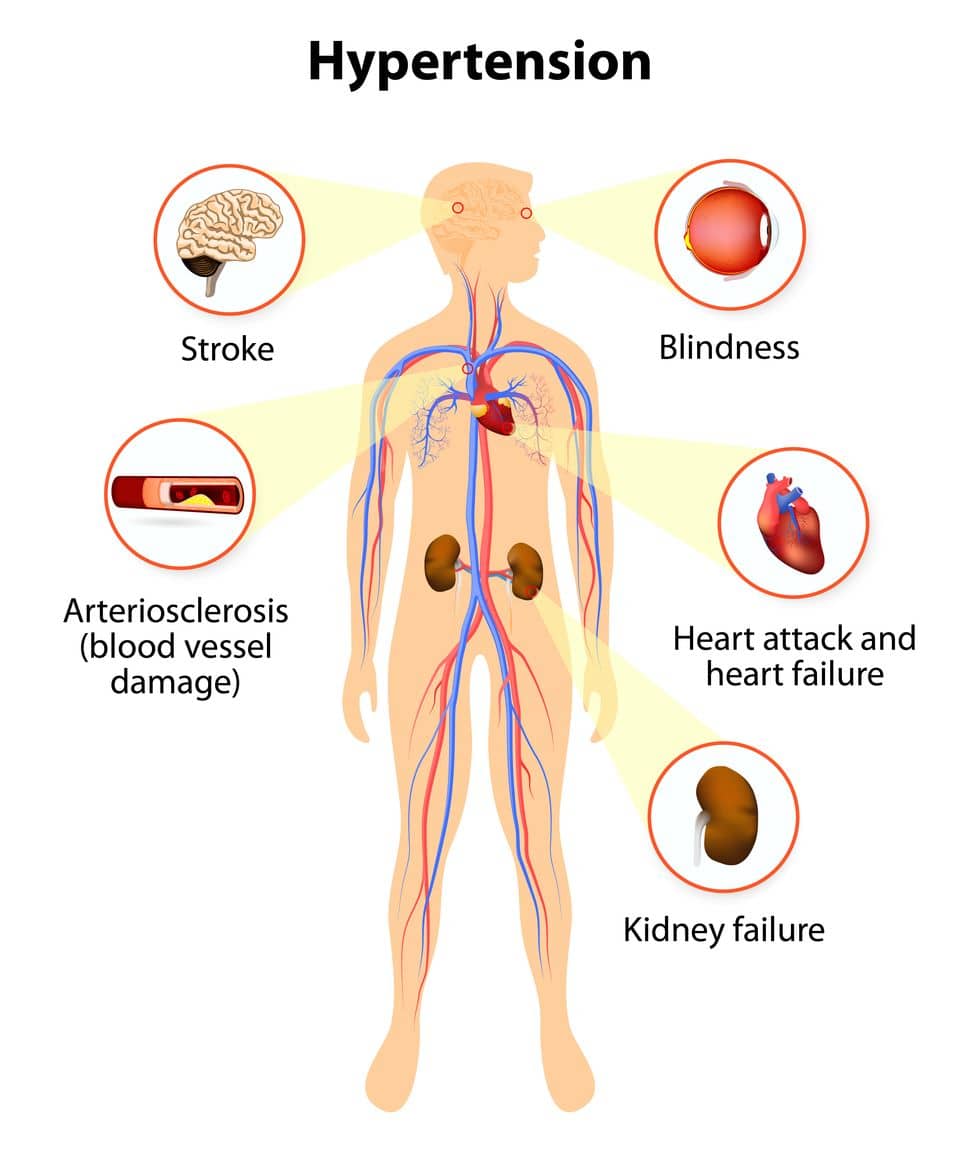 Hypertension