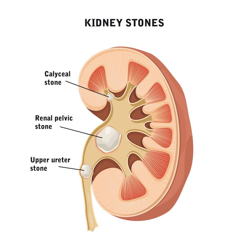 Kidney Stones 