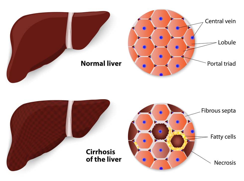 Liver cirrhosis