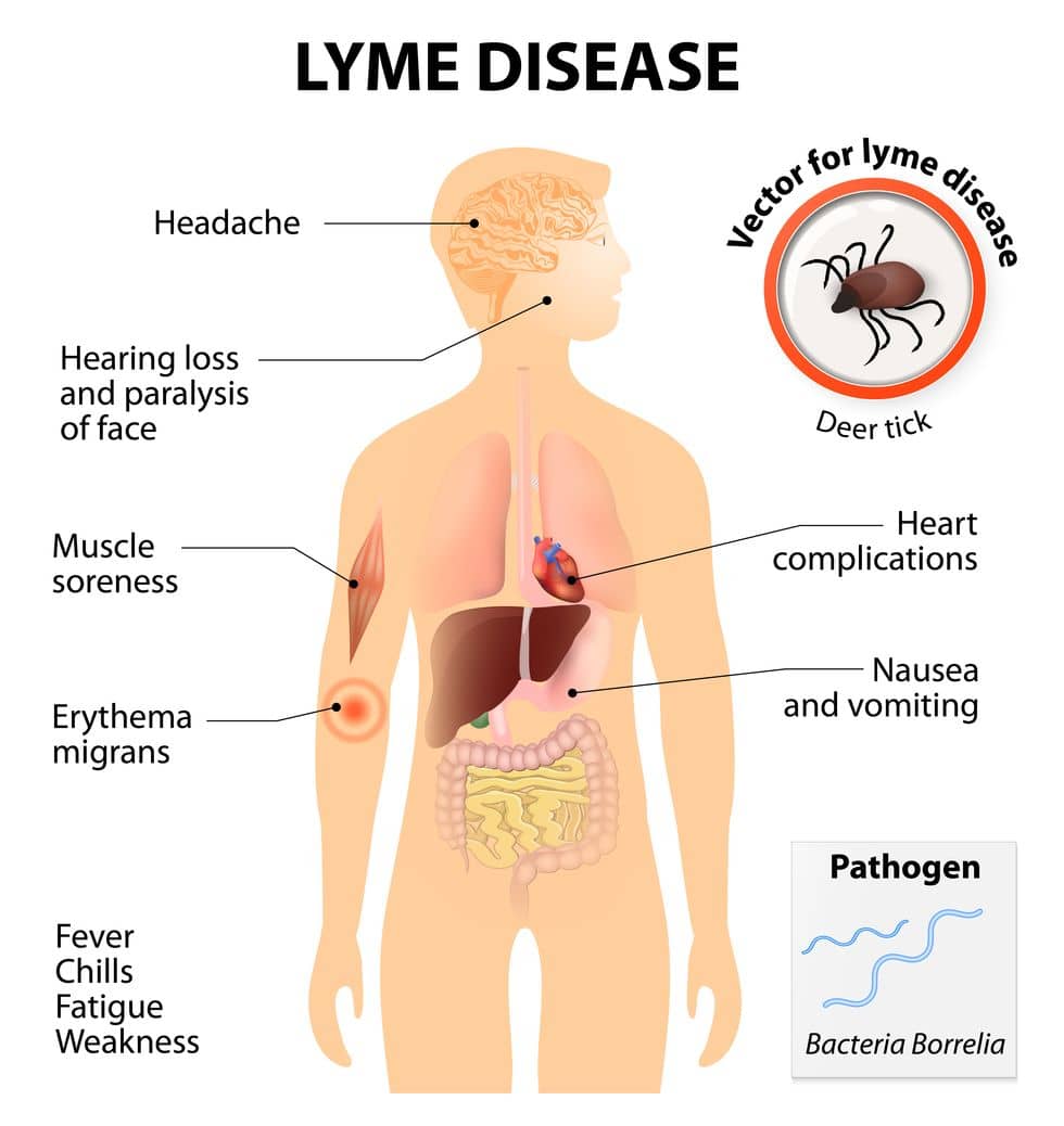 Lyme disease 