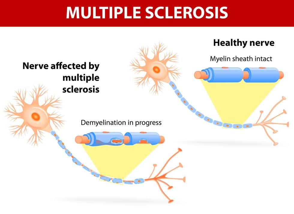 Multiple Sclerosis