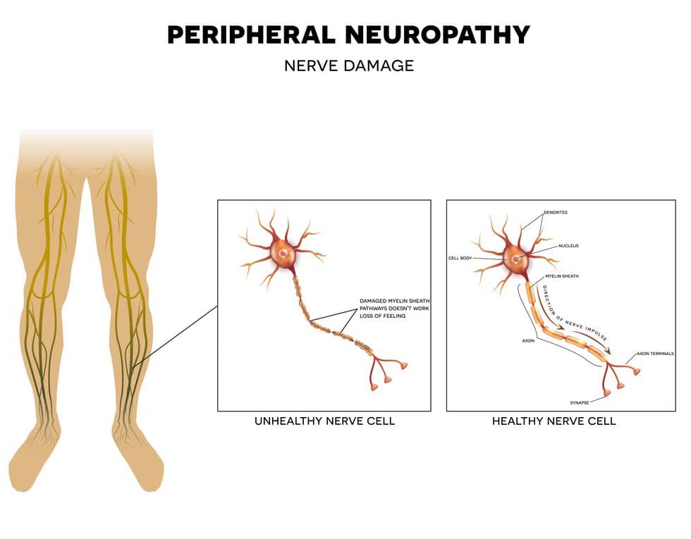 Perpheral neuropathy