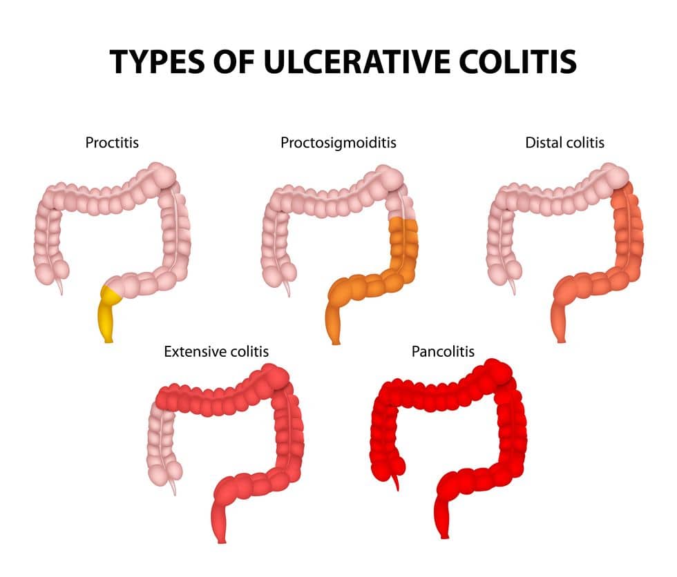 Ulcerative Colitis 